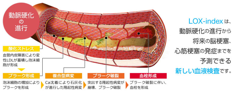 池袋東口徒歩3分｜池袋セントラルクリニック｜脳梗塞・心筋梗塞リスクマーカー（ Lox-index 検査 ）検査