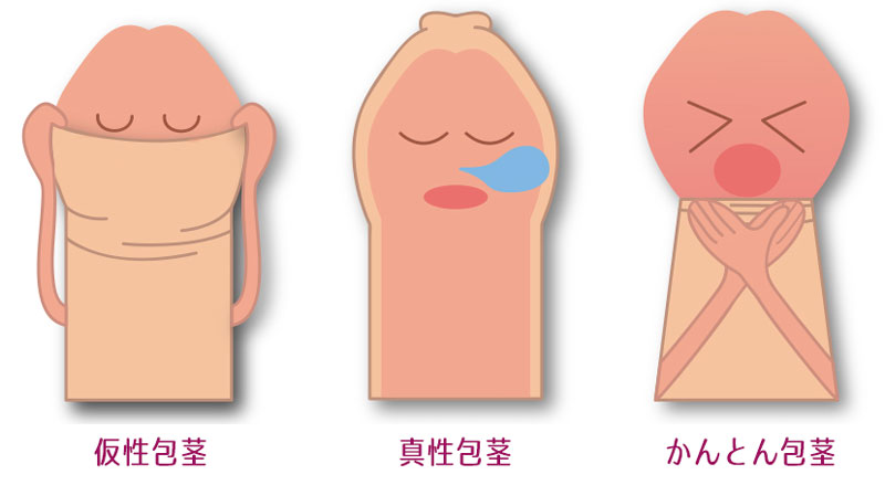 池袋東口徒歩3分｜池袋セントラルクリニック｜包茎・男性器治療　包茎の様々なタイプ