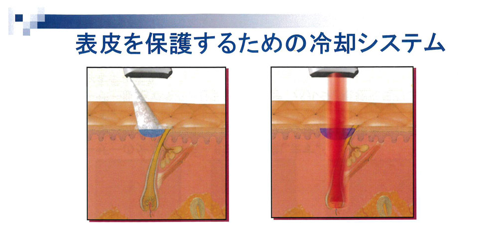 池袋セントラルクリニック｜医療レーザー脱毛・完全マニュアル